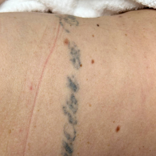 tattoo verwijderen met pico laser