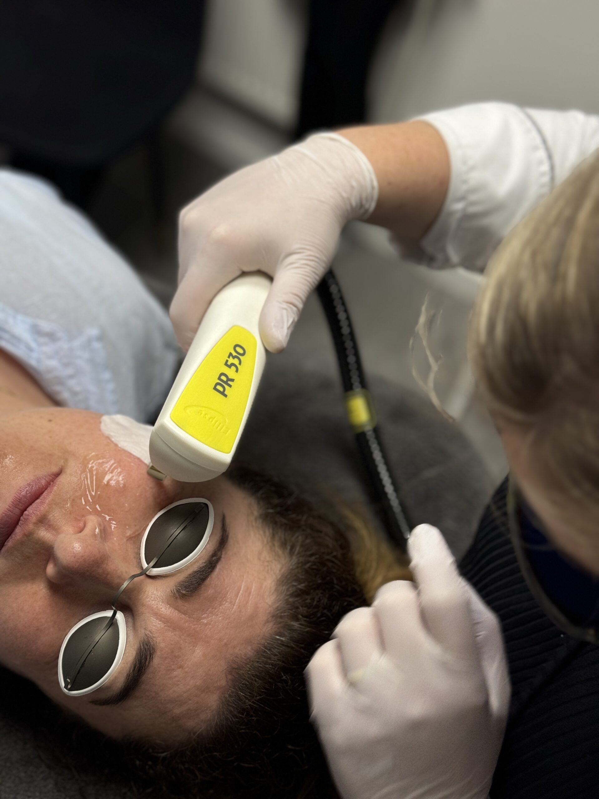 Nordlys laser tegen vaatjes en roodheden